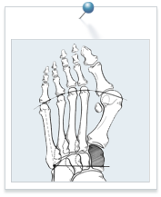 Hallux valgus